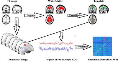 Distributed Functional Connectome of White Matter in Patients With Functional Dyspepsia